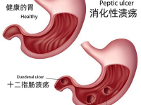 胃溃疡的自然疗法