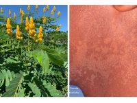 水疱性癣的自然疗法