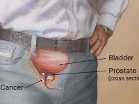 前列腺疾病的几种自然疗法