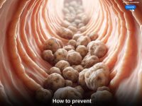 管道问题 - 输尿管结石指南