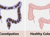 结肠清洁是最有效但却被忽视的健康干预措施