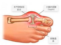 使用这 7 种天然疗法消除尿酸并缓解关节炎疼痛！