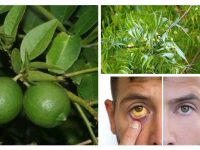 治疗黄疸最快的方法