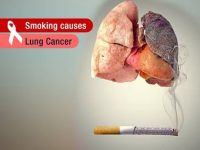 关于肺癌