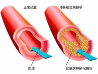 动脉不需要“清洗”，他们需要疗愈